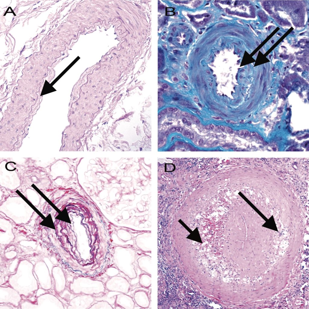 Banff Lesion Score cv (vascular fibrous intimal thickening). 