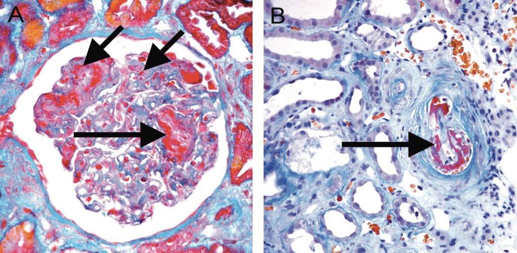 Acute TMA. A, Acute TMA affecting a glomerulus with fibrin thrombi (long arrows) and fragmented red blood cells (short arrow) in capillary loops.