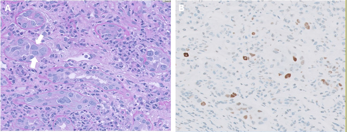 Banff Lesions Score i-IFTA (inflammation in areas of IFTA).